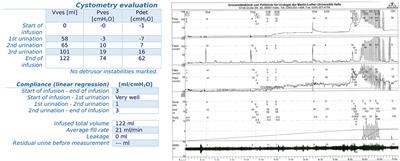 De novo OAB After ATOMS: An Underestimated Problem or a Rare Side Effect?